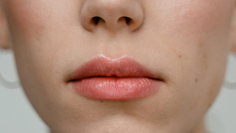 Jak wygląda zabieg powiększania ust kwasem hialuronowym?